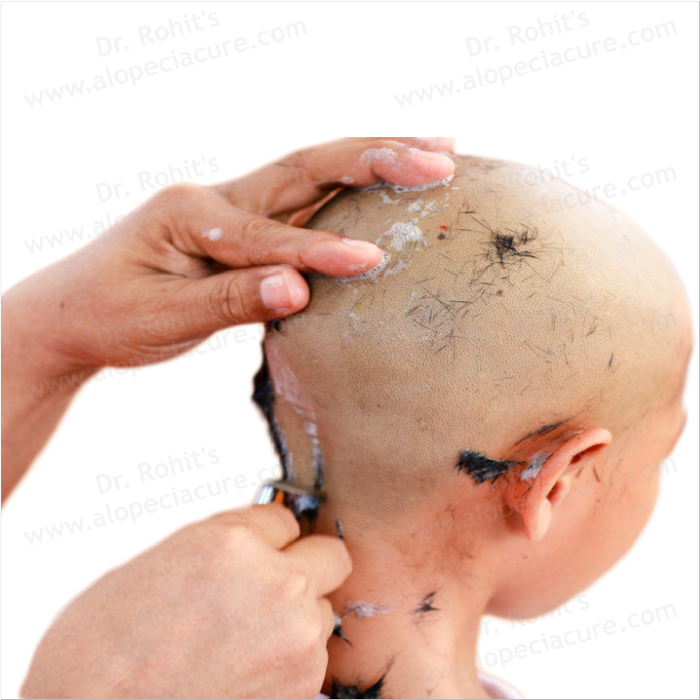 Shave off entire scalp myth
